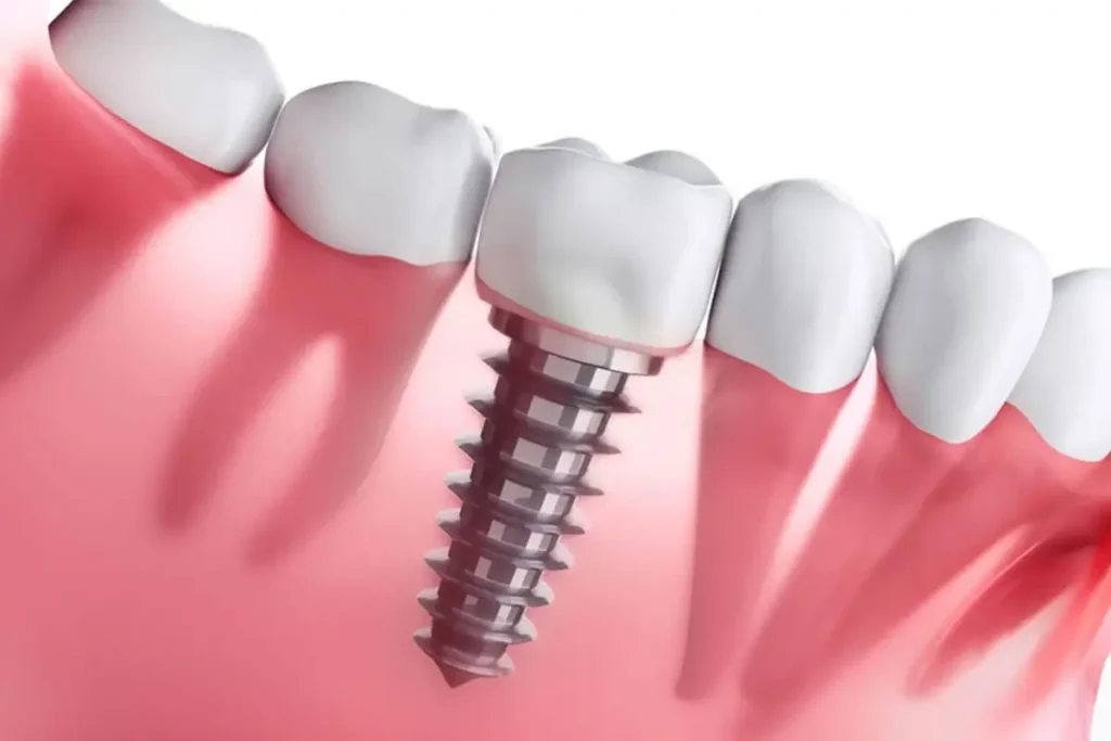 Aplicativo sobre implante dentário